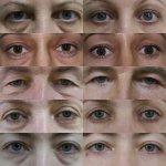 Blepharoplasty_zholtikov.jpg